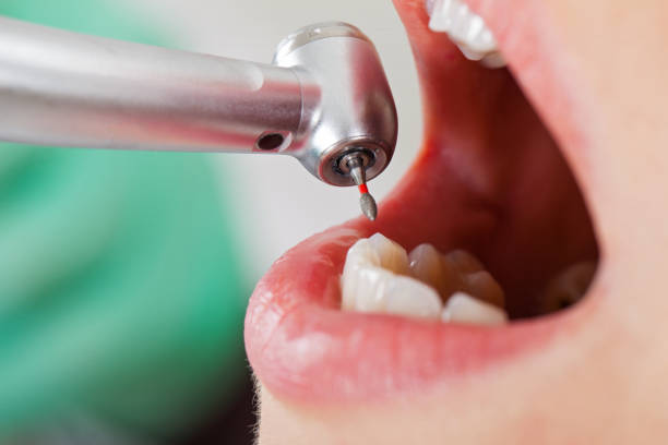 Best Emergency Root Canal Treatment in Burnt Mills, MD